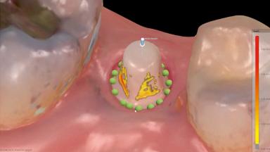 Guided Immediate Placement of a Ceramic Implant in a Maxillary Right ...