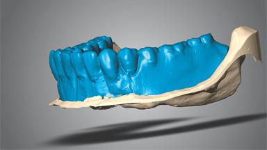 Mandibular Overdenture Supported by a CAD/CAM-milled Bar with Long ...