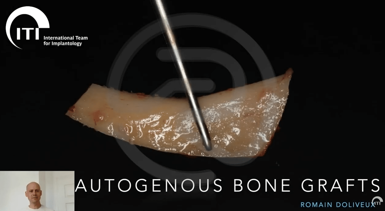Autogenous bone augmentation: bone core technique & shell technique ...