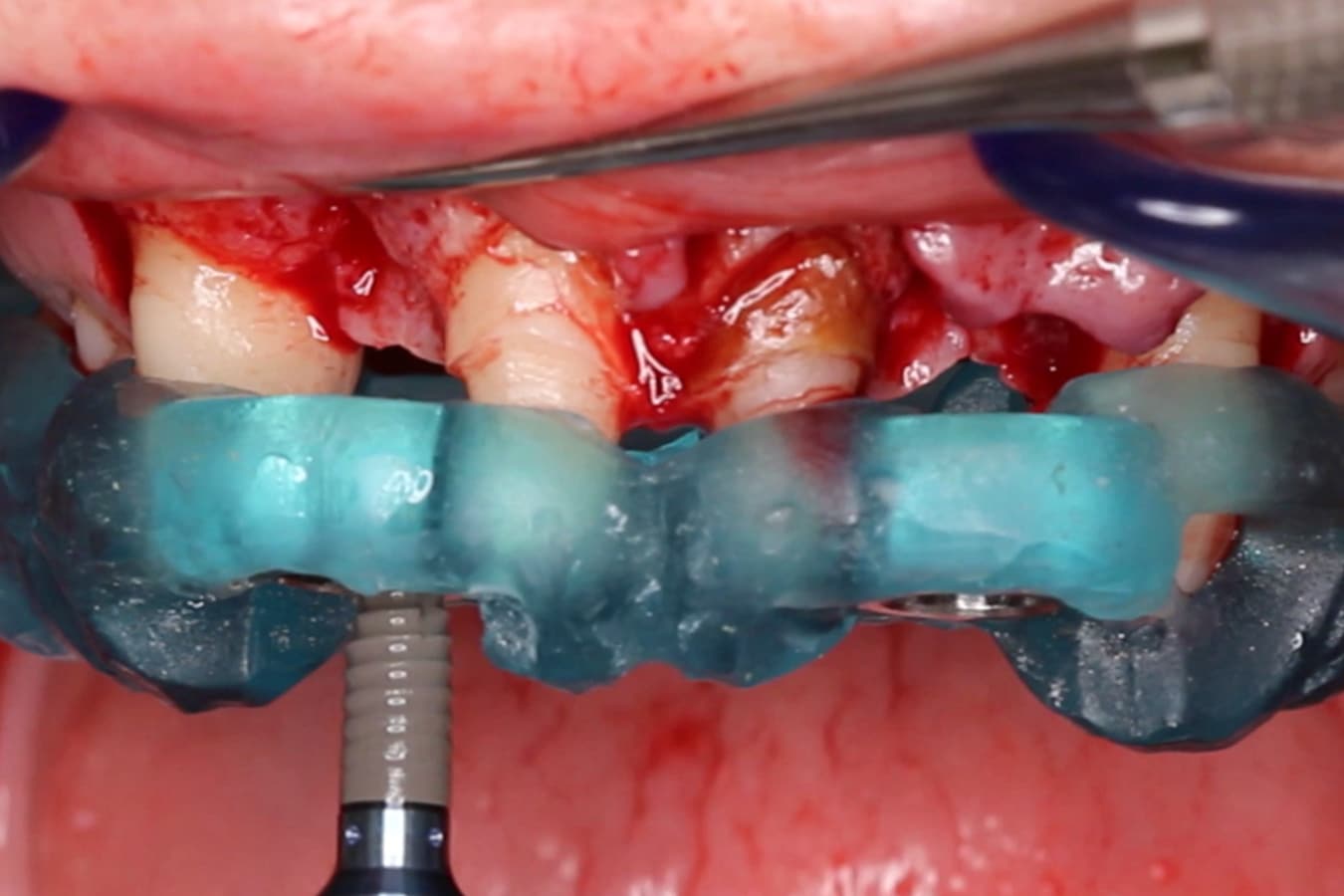 Frontal view with 3D-printed surgical guide for bilateral single tooth implant replacement